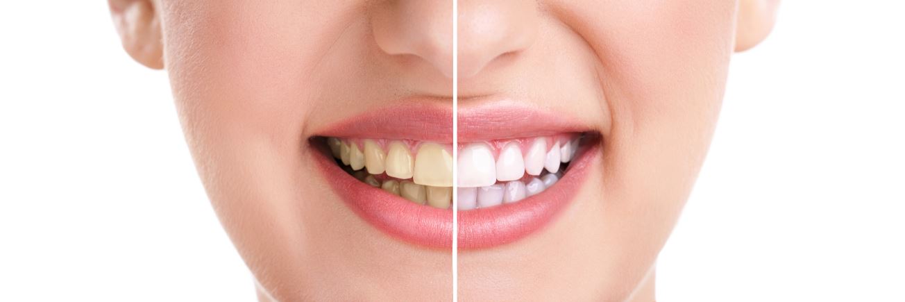 teeth whitening